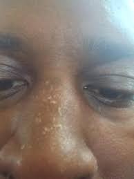 Ahead, discover everything you need to know about sunburn and skin cancer risk for dark skin tones. 50shadesofjay On Twitter Black People Sunburn For Real Damn Sun Uva Doesn T Discriminate Http T Co No3m1qqiec