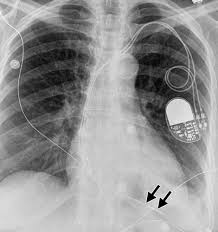 International normalized ratio (inr) is a measure of the extrinsic pathway of coagulation. Radiography Of Cardiac Conduction Devices A Comprehensive Review Radiographics