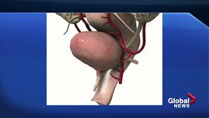Cancer is the name given to an abnormal division of cells that the body fails to control and starts having its own blood supply. Women Likely To Ignore Early Signs Of Bladder Cancer Doctor Globalnews Ca
