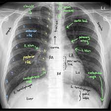 A method for examining a chest. Reading Chest X Rays Anatomy Labelled Reading A Grepmed