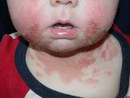 Dermatitis De Contacto Irritante Hoogstra Centros Medicos