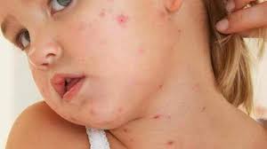 كيف تعالجين الحبوب الحمراء لطفلك بالمنزل مجلة سيدتي