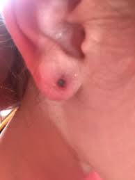Maybe you would like to learn more about one of these? Mum Blasts Claire S After Her Daughter S Piercing Had To Be Dug Out Of Her Infected Ear And Left Her On Sepsis Watch