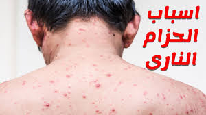 الحزام الناري هو عبارة عن طفح جلدي يظهر على سطح الجلد ويشبه الحزام، يلتف حول الجلد من ناحية إحدى جانبي الخصر، ويعتبر السبب الرئيسي وراء ظهور الحزام الناري هو فيروس الذي يسبب الجدري المائي أو ما يعرف بالحماق، فعند الإصابة بالجدري في الصغر يظل الفيروس في النسيج العصبي غير. ØºØ±ÙŠØ¨ Ù†ÙˆØ¹ Ù…Ù† Ø§Ù„Ù‚Ø·Ø§Ø±Ø§Øª ÙƒÙ…Ø§Ù† Ø¹Ù„Ø§Ø¬ Ø­Ø²Ø§Ù… Ø§Ù„Ù†Ø§Ø±ÙŠ Ø¨Ø§Ù„Ø§Ø¹Ø´Ø§Ø¨ Guillotinpoilvet Com