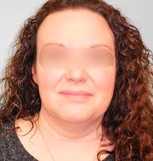 Plastic Surgery Photos