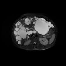 Polycystic Liver Disease Radiology Case Radiopaedia Org