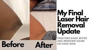 Surprisingly, laser hair removal bikini is also a good option to get rid of hair from the most sensitive areas of your body. Laser Hair Removal Results On Dark Skin Dark Spots On Bikini Line Kamrin White Youtube
