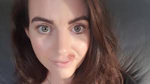 Image result for skin cancer on nose pimple
