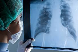 Image result for Chest XRay