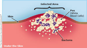 This type of bacteria is resistant to many different antibiotics. Mrsa For Teens Nemours Kidshealth