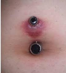 Fixing Piercings Gone Wrong Painful Pleasures Community