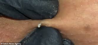 Natural remedy for ingrown hair with essential oil. Ingrown Hair Pussy Ingrown Hair