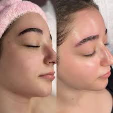 Anti-aging HydraFacial result in Thane