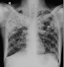 Case contributed by dr brenda lee solorzano frontal chest x ray shows bilateral micronodular insterstitial effusion. Pulmonary Tuberculosis Radiology Case Radiopaedia Org