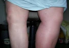 In other areas, you may feel pain due to a loss of oxygen to. In Pregnancy Dvt Mostly Occurs In Left Leg Medpage Today