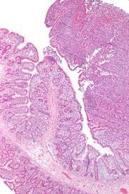 Symptoms can include severe abdominal (belly) pain, nausea, vomiting and bleeding from the intestine. T Cell Lymphoma Wikipedia