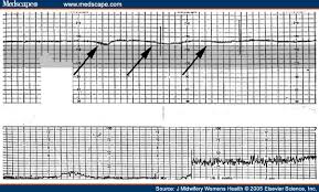 Image result for Late Deceleration