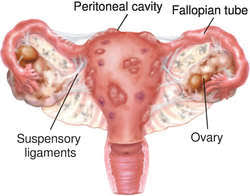 Learn about what is endometriosis and the symptoms of endometriosis explained by. Endometriosis Externa Definition Of Endometriosis Externa By Medical Dictionary