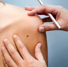 01.01.2020 · odd skin sensations, such as persistent itchiness or tenderness. Skin Cancer How To Check Your Moles And Spot Cancer Signs Early
