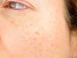 Sunbeds increase your risk of skin cancer and are not recommended for enhancing vitamin d levels. Photoaging Sun Damage Fact Sheets Yale Medicine