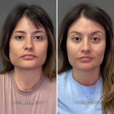 Albuquerque Chin & Jaw Before & After Gallery: Chrome Aesthetics