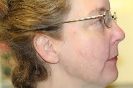 Before and After Invisalign Class II div 2