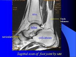The muscles are located mainly in the sole of the foot and divided into a central (medial) group and a group on either side (lateral). The Sectional Anatomy Of Limbs And Mri The