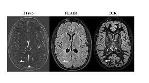 › verified 6 days ago. Non Contrast Mri Proves Effective In Monitoring Ms Patients Technology Networks