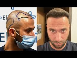 L'età degli uomini interessati a questo tipo d'intervento oscilla tra i 20 e i 60. Trapianto Capelli In Turchia Dal N 1 In Europa Elithair