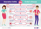 Ulcerative Colitis and Crohn's Disease: What's the Difference ...