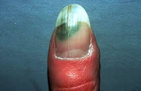 Black mark under nail is nearly always blood. 12 Nail Changes A Dermatologist Should Examine