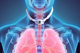 Tracheostomy Tube Cuff Management The Road To Decannulation Dysphagia Cafe