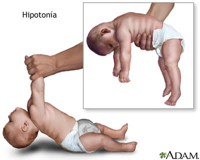 Resultado de imagen para hipotonia"