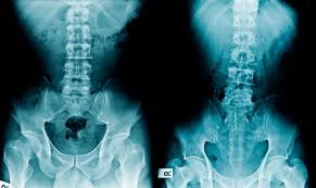 How Degenerative Disc Disease Progresses