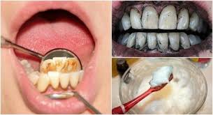 Come Rimuovere Il Tartaro A Casa Usando Il Bicarbonato Di Sodio Rimedi Naturali Rimedi Pulire I Denti