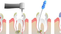 Image result for the first step in a root canal treatment is which of the following?