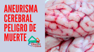 O aneurisma cerebral é uma dilatação localizada de uma pequena porção de uma artéria intracraniana. Aneurisma Cerebral Peligro De Muerte Youtube