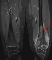A type of bone cancer called osteosarcoma is the most common type of primary bone cancer in dogs, accounting for over 95% of all bone tumors. Osteosarcoma Orthoinfo Aaos