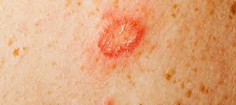 Was Ist Hautpilz Der Umfassende Uberblick Zu Hautpilz