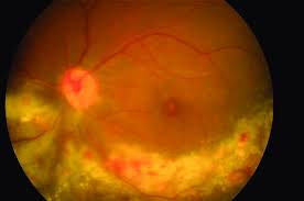 Image result for HIV Retinitis