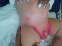 This rash is caused by a fungus or bacteria and can appear anywhere your skin rubs. Intertrigo Of Streptococcal Aetiology A Different Kind Of Diaper Dermatitis Bmj Case Reports