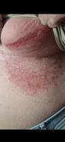 Image result for heat rash under breasts