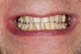 Image result for Tooth Discoloration
