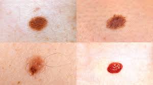 In the united states, it's estimated that doctors diagnose over 100,000 new skin cancer cases each year. Skin Moles Types Causes And Skin Care
