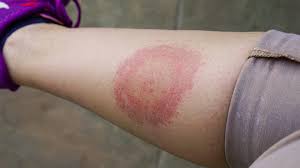 Lyme Disease Symptoms Progression And When To See A Doctor
