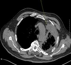 And imaging tests such as ct scans, mri and pet/ct scans. Diffuse Epithelioid Malignant Mesothelioma Of The Pleura Presenting As A Hydropneumothorax And Vertebral Body Invasion Bmj Case Reports