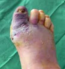 Image result for diabetic toes