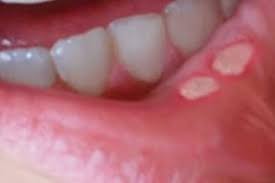 El dentista me recetó un enjuague para curar las postemillas que tenía en la boca. Aftas Bucales Causas Emocional Y Como Eliminarlas Rapidamente