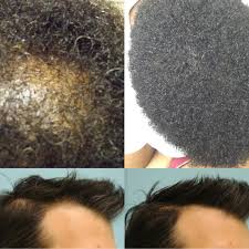 Rogaine Foam Men's Hair Regrowth Treatment 60g (3-Month Supply)