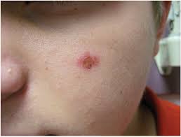 Image result for yellow scabs on the face in children